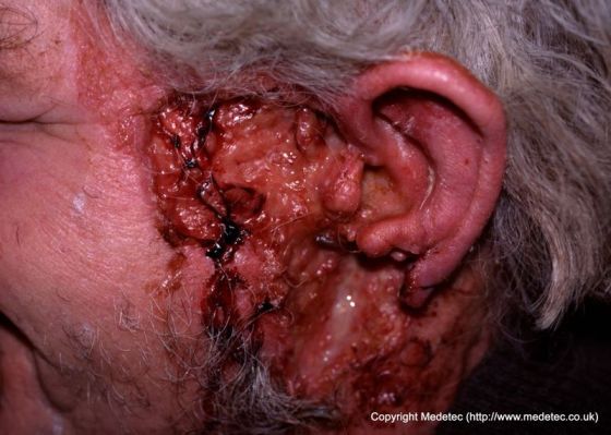 Large fungating malignant wound on face